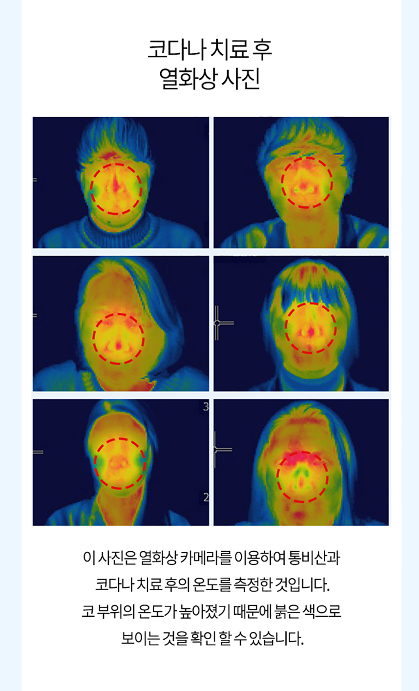 코다나 치료 후 열화상 사진 코부위의 온도가 높아졌기 때문에 붉은 색으로 보이는 것을 확인 할 수 있습니다.