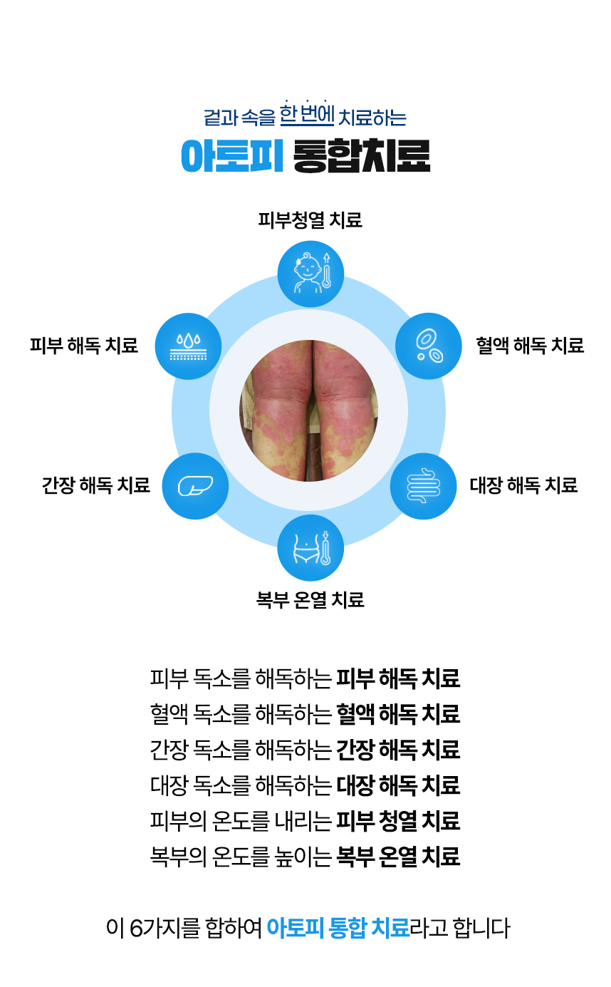 겉과 속을 함번에 치료하는 아토피 통합치료 / 사중독소 장독소, 간독소, 혈액독소, 피부독소 사중독소의 4중 해독 치료 피부, 피부의 열을 내리는 피부 청열 치료, 복부의 온도를 높이는 복부 온열 치료