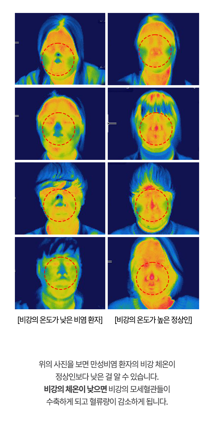 아래는 열화상카메라로 촬영한 사진으로 비염 환자의 비강 체온이 정상인보다 낮은 걸 알 수 있습니다.