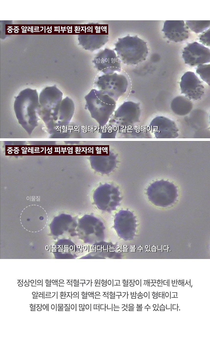 정상인의 혈액은 적혈구가 원형이고 혈장이 깨끗한데 반해서, 알레르기 환자의 혈액은 적혈구가 밤송이 형태이고 혈장에 이물질이 많이 떠다니는 것을 볼 수 있습니다.