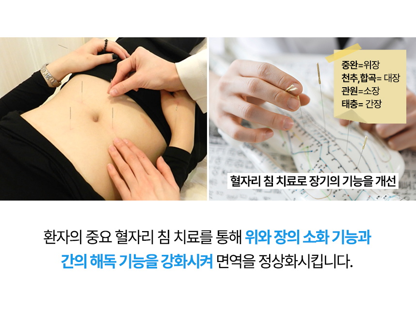 환자의 중요 혈자리 침치료를 통해 위와 장의 소화기능과 간의 해독기능을 강화시켜 면역을 정상화 시킵니다.