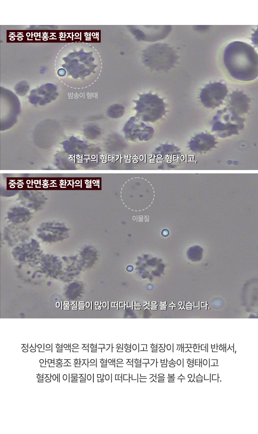 정상인의 혈액은 적혈구가 원형이고 혈장이 깨끗한데 반해서, 안면홍조 환자의 혈액은 적혈구가 밤송이 형태이고 혈장에 이물질이 많이 떠다니는 것을 볼 수 있습니다.