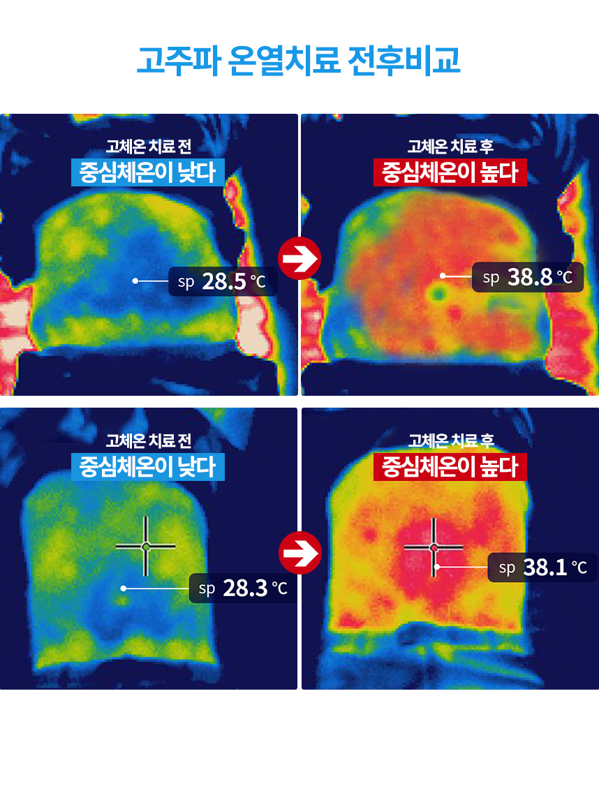 고주파 온열치료 전후비교