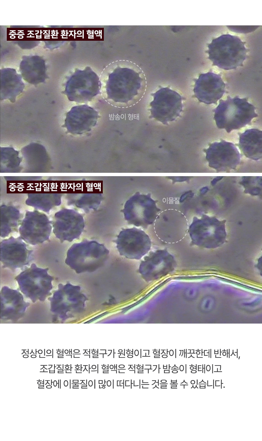 정상인의 혈액은 적혈구가 원형이고 혈장이 깨끗한데 반해서, 조갑질환 환자의 혈액은 적혈구가 밤송이 형태이고 혈장에 이물질이 많이 떠다니는 것을 볼 수 있습니다.