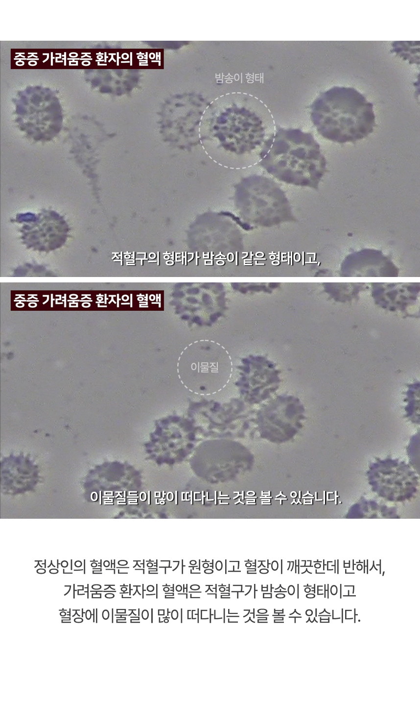 정상인의 혈액은 적혈구가 원형이고 혈장이 깨끗한데 반해서, 가려움증 환자의 혈액은 적혈구가 밤송이 형태이고 혈장에 이물질이 많이 떠다니는 것을 볼 수 있습니다.