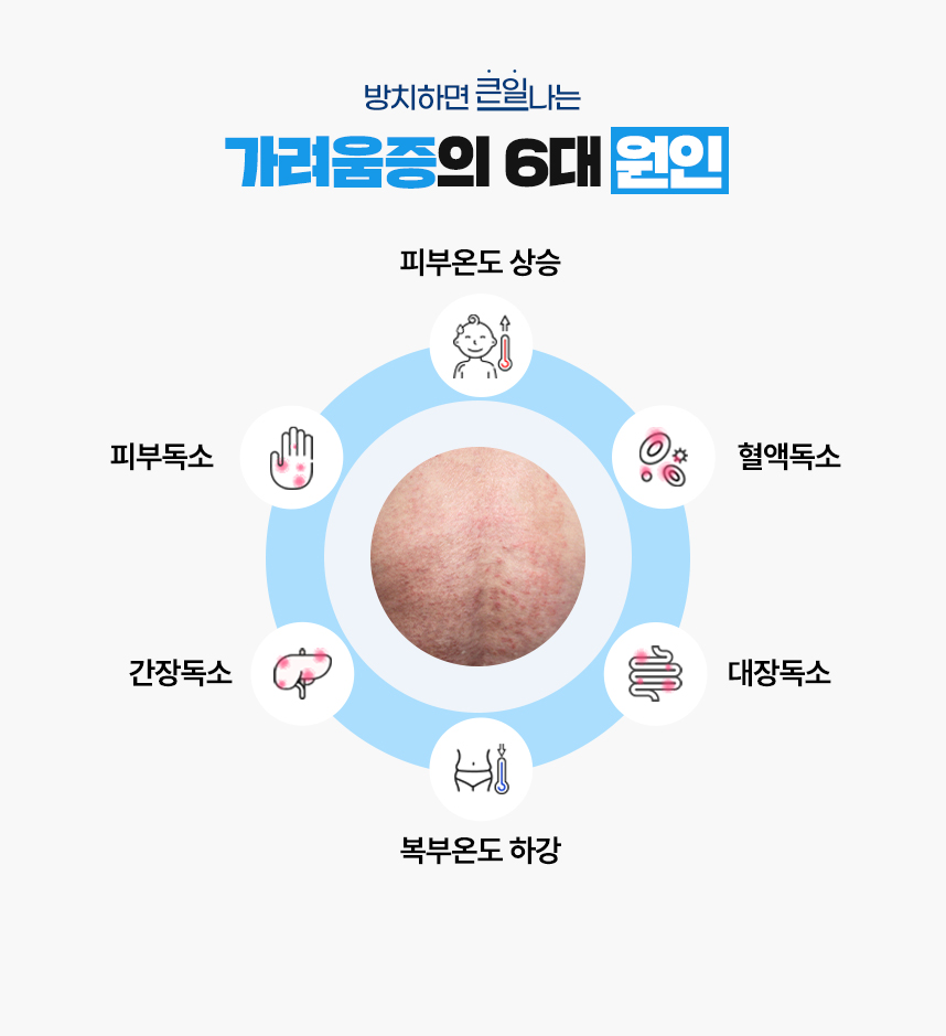 또한 가려움증 증상이 있는 피부 온도는 높게 상승되어 있고 복부 온도는 낮게 하강되어 있는 병리적인 특성이 있어 이 6가지를 가려움증이 발병하는 6대 원인으로 보고 있습니다.