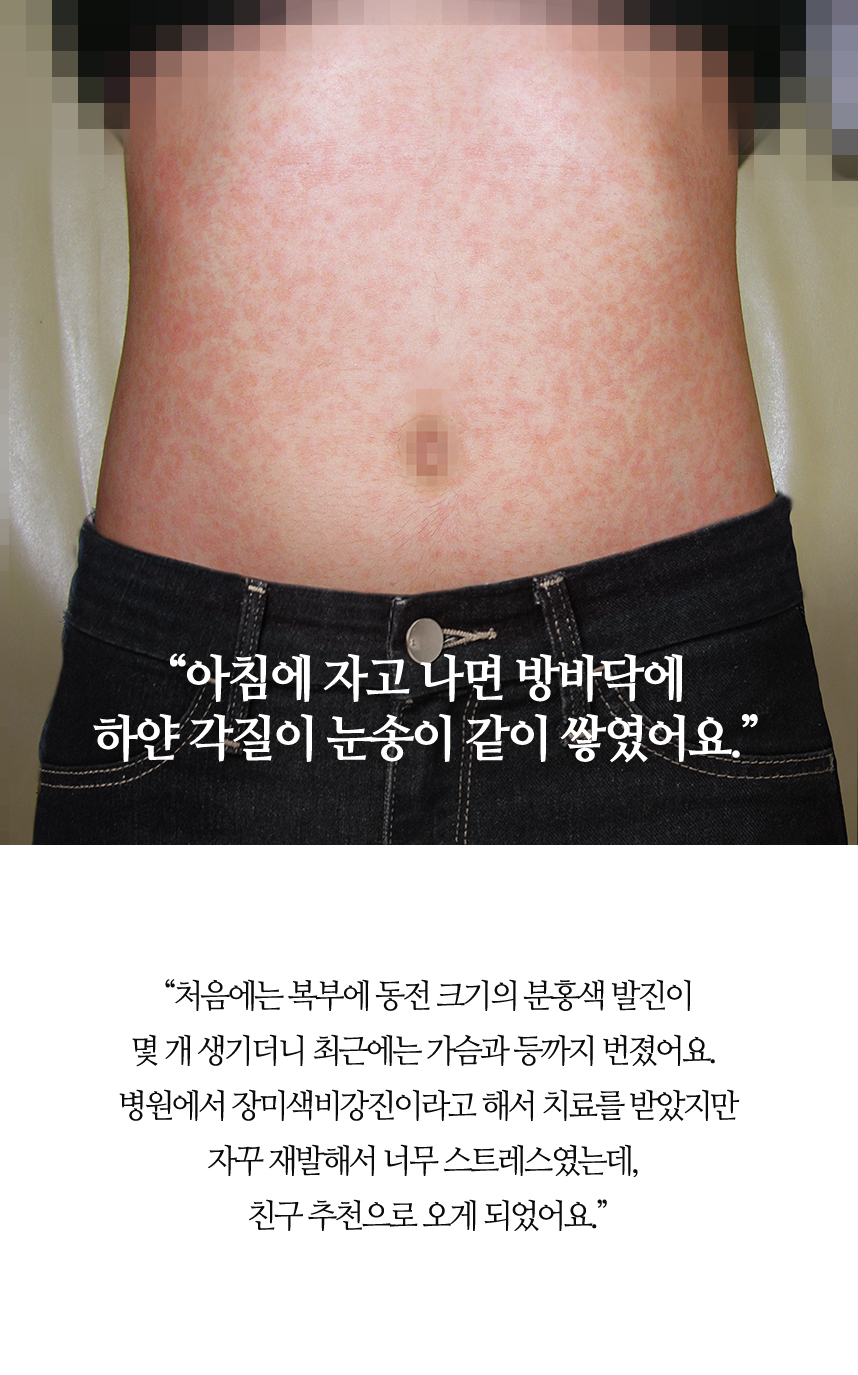 아침에 자고 나면 방바닥에 하얀 각질이 눈송이 같이 쌓였어요.