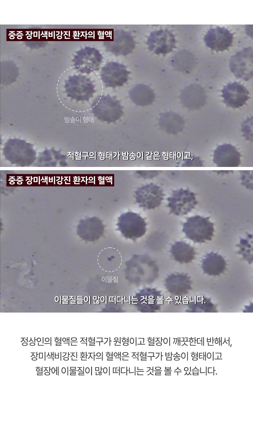 정상인의 혈액은 적혈구가 원형이고 혈장이 깨끗한데 반해서, 장미색비강진 환자의 혈액은 적혈구가 밤송이 형태이고 혈장에 이물질이 많이 떠다니는 것을 볼 수 있습니다.