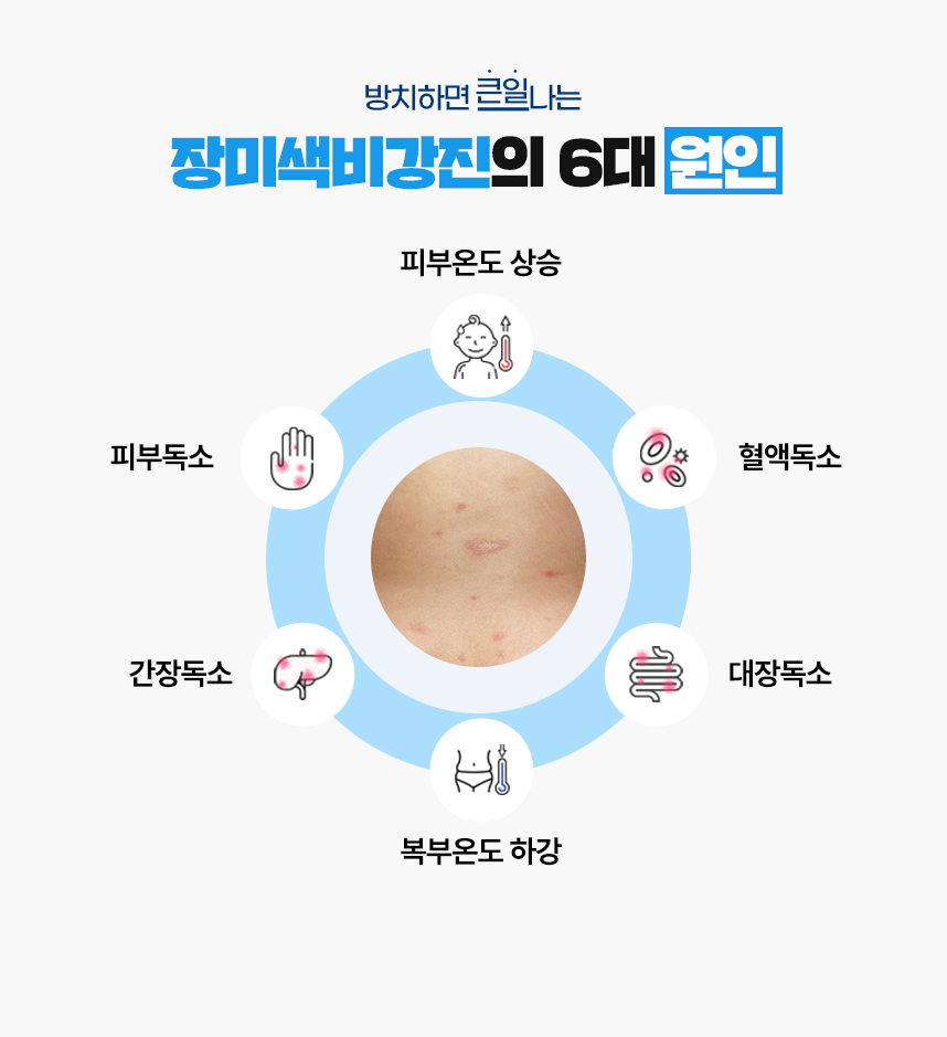 또한 장미색비강진 증상이 있는 피부 온도는 높게 상승되어 있고 복부 온도는 낮게 하강되어 있는 병리적인 특성이 있어 이 6가지를 장미색비강진이 발병하는 6대 원인으로 보고 있습니다.