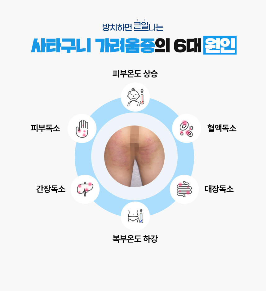 또한 사타구니 가려움증 증상이 있는 피부 온도는 높게 상승되어 있고 복부 온도는 낮게 하강되어 있는 병리적인 특성이 있어 이 6가지를 사타구니 가려움증이 발병하는 6대 원인으로 보고 있습니다.