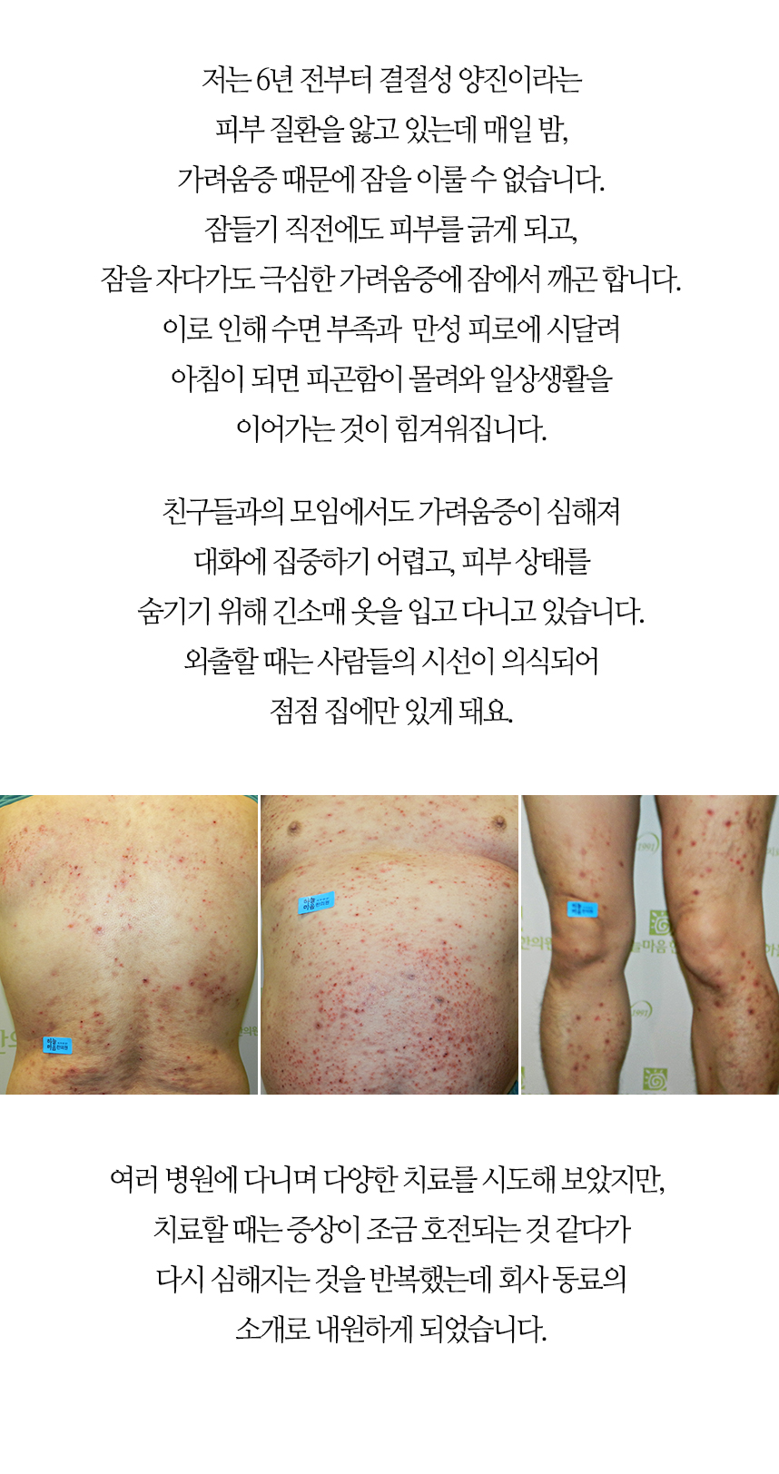 6년전부터 결절성 양진을 앓고 있는데 매일밤 가려움에 잠을 이룰 수 없고, 수면부족과 만성피로에 일상생활이 힘듭니다.