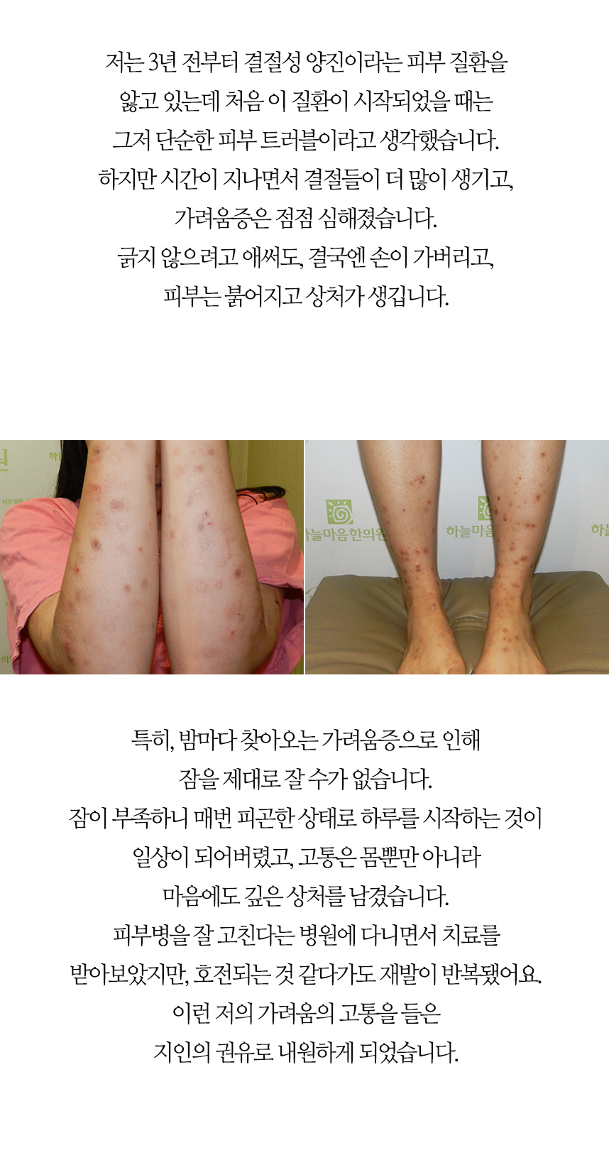 3년전부터 결절성 양진을 앓고 있는데 시간이 지날수록 결절들이 많이 생기고 가려움증은 점점 더 심해졌습니다.