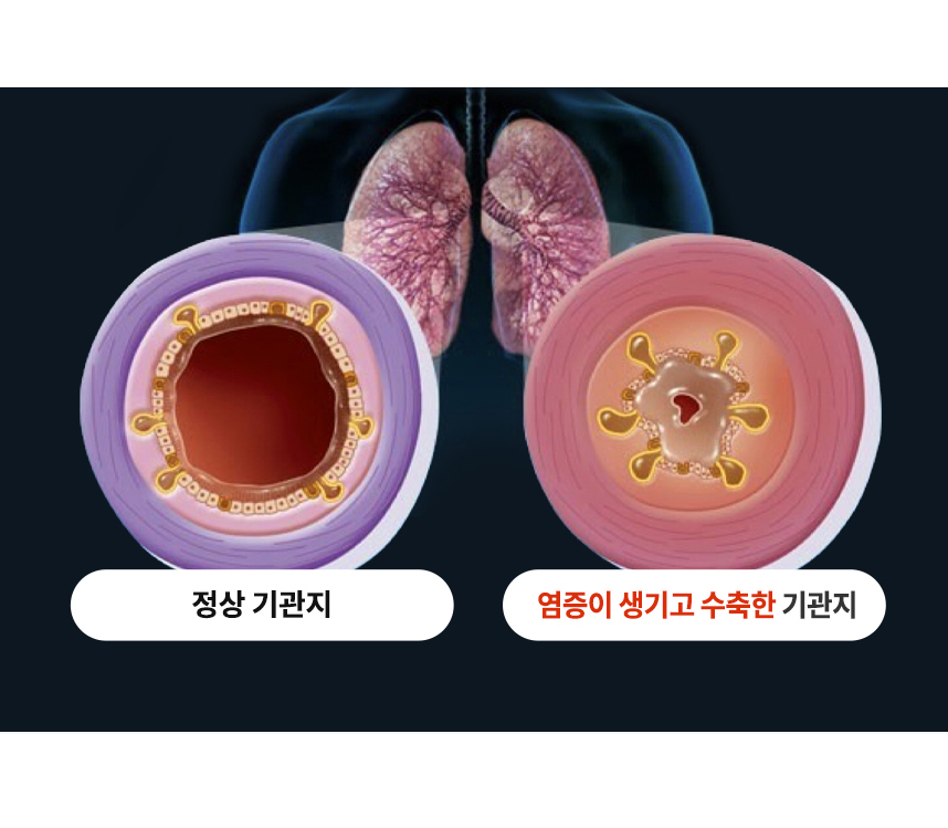 섬모기능 저하 세균과 바이러스 증식. 비점막 비후로 코막힘, 콧물, 후비루 증상. 점액분비 증가 세균과 바이러스 증식