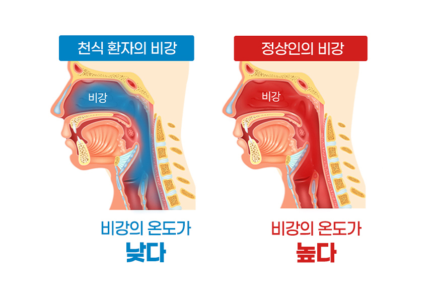 비염환자의 비강 온도 측정