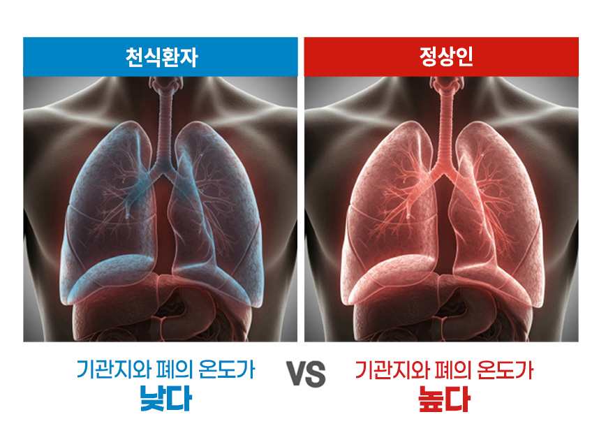비염환자 : 비강의 온도가 낮다, 정상인 : 비강의 온도가 높다