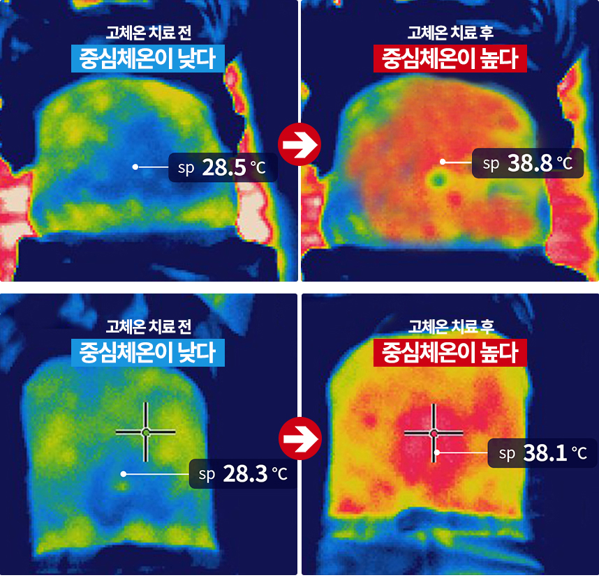  고체온 온열치료 효과 