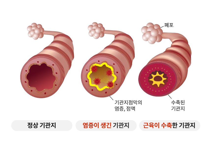 정상인의 기관지와 염증이 생기고 근육이 수축한 천식 환자의 기관지