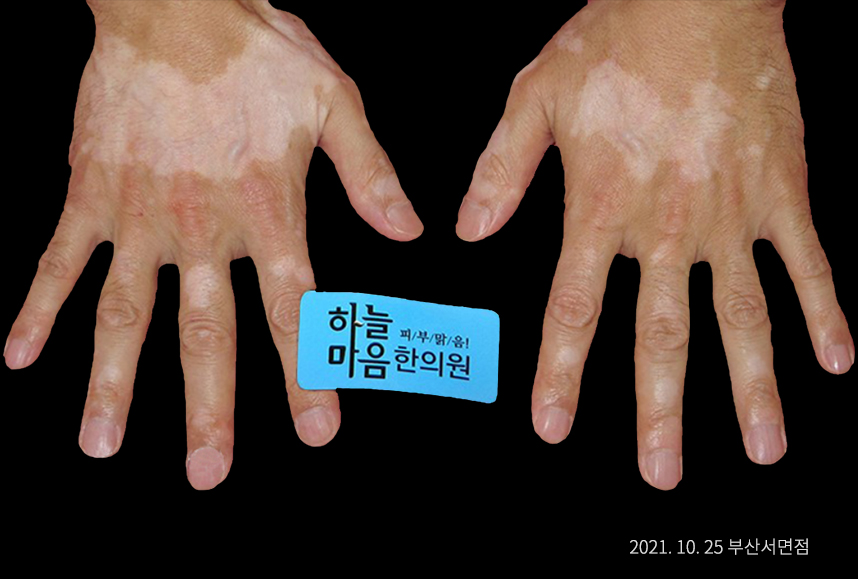 피부 속 독소