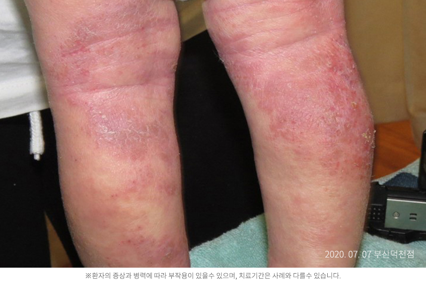 소아 아토피