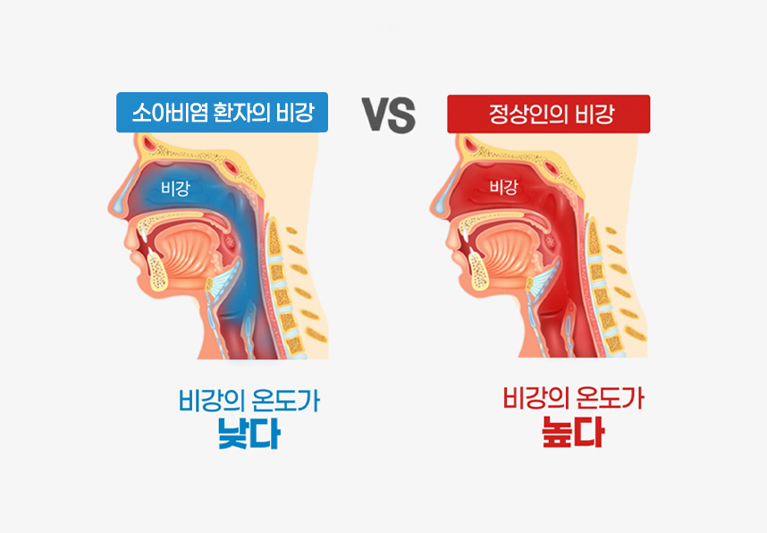 소아비염 환자 : 비강의 온도가 낮다, 정상인 : 비강의 온도가 높다