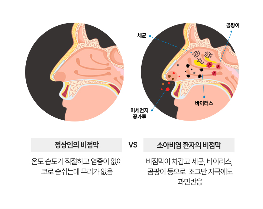 정상인의 비점막 : 온도 습도가 적절하고 염증이 없어 코로 숨쉬는데 무리가 없음. 비염환자의 염증이 생긴 비점막 : 비점막이 차갑고 세균, 바이러스, 곰팡이 등으로  조그만 자극에도 과민반응