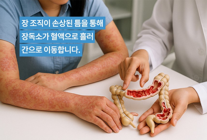 소아 아토피의 원리에 대해 설명하는 하늘마음한의원 한의사 