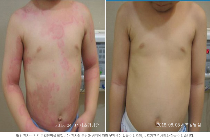 두드러기 병력 8개월 8세 남아