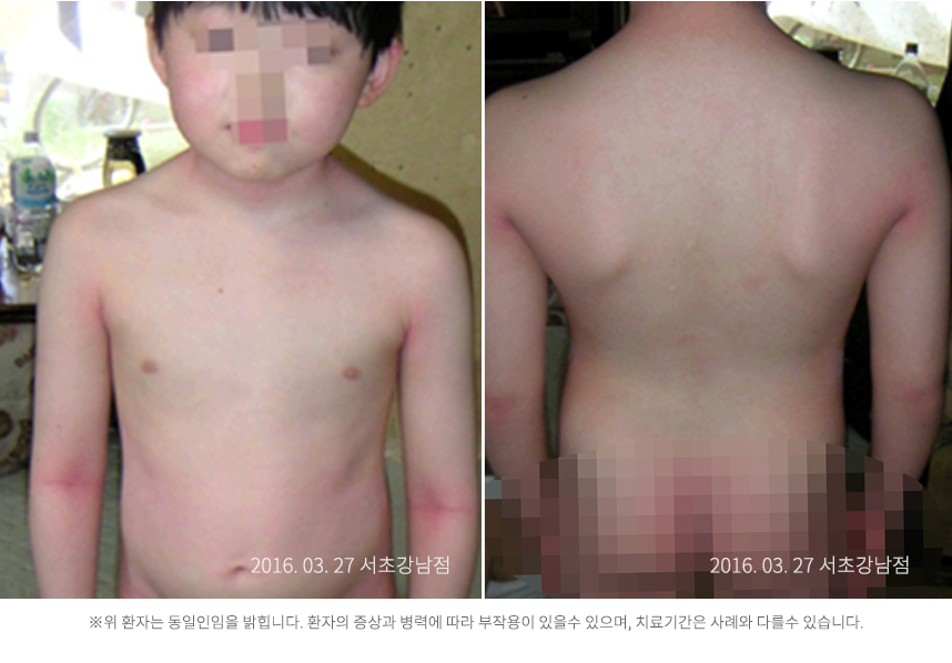 하늘마음한의원 청열 해독후 건선이 치료된 모습