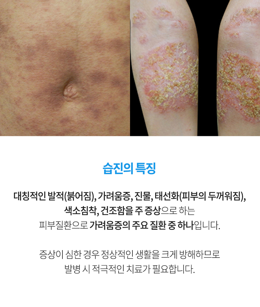 피부 가려움증의 원인 4가지 증상과 관리방법 2